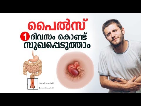 പൈൽസ് ഒരു ദിവസം കൊണ്ട് സുഖപ്പെടുത്താം | Piles Malayalam Health Tips