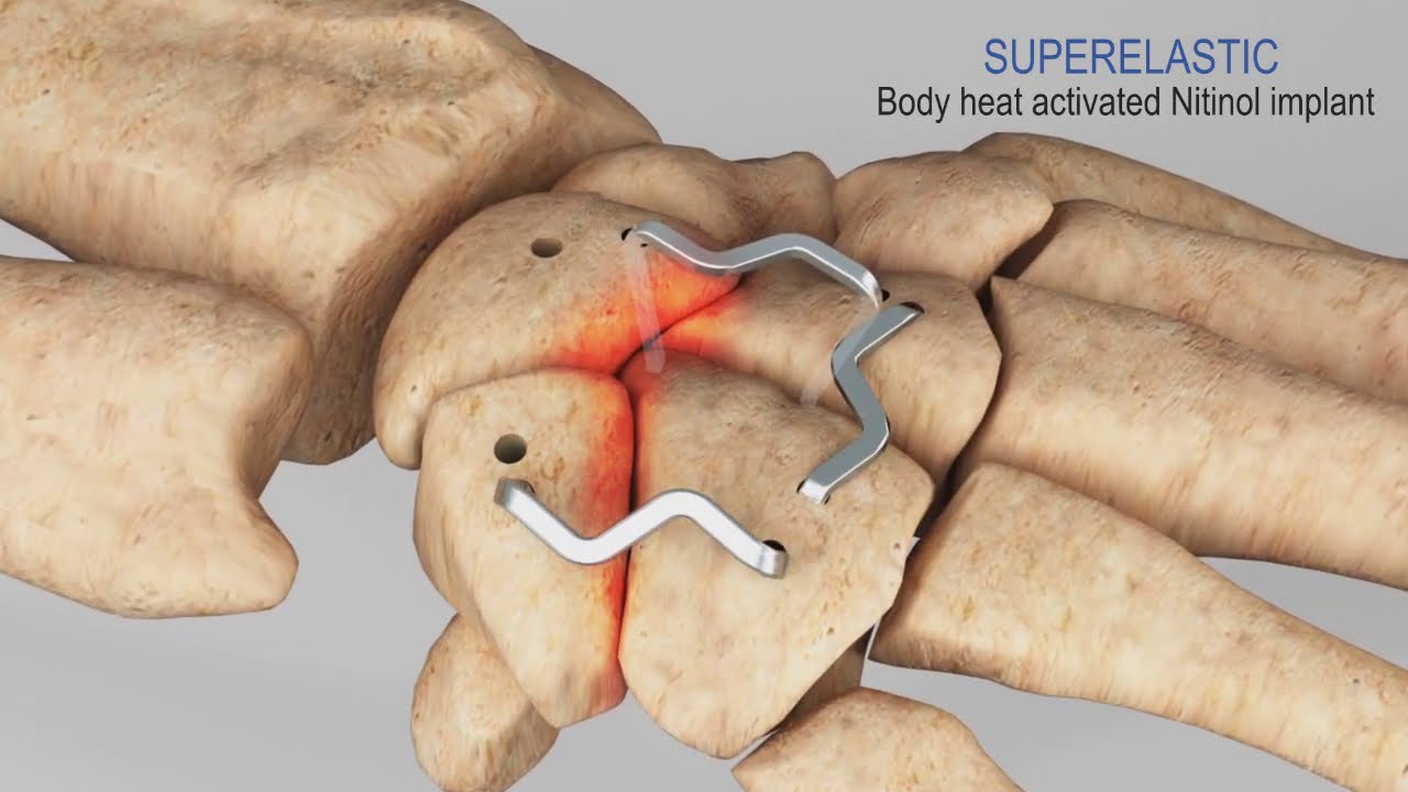 InstaFix Shape Memory Fixation System
