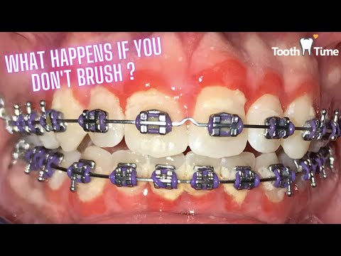 YouTube video about: How long after a deep cleaning can I get braces?