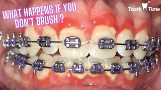 What happens if you don't brush your teeth properly with braces? Tooth Time Family New Braunfels