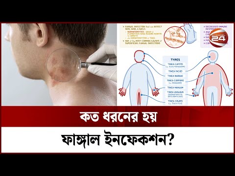 কত ধরনের হয় ফাঙ্গাল ইনফেকশন? | Fungal Infection | Channel 24
