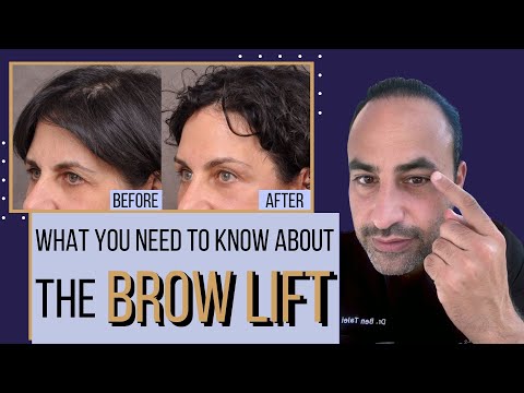 What You Need To Know About The Brow Lift | Dr. Ben Talei Beverly Hills, Los Angeles