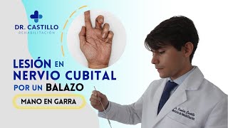 Neuropatía cubital por lesión de arma de fuego