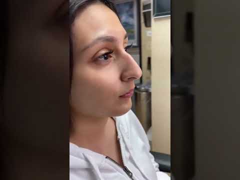 Scarless Nose™️ Rhinoplasty 1 year postop! 7 day rapid recovery and can fly back to your home!