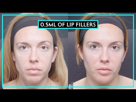 How Much Difference Does 0.5ML Of Lip Fillers Make?
