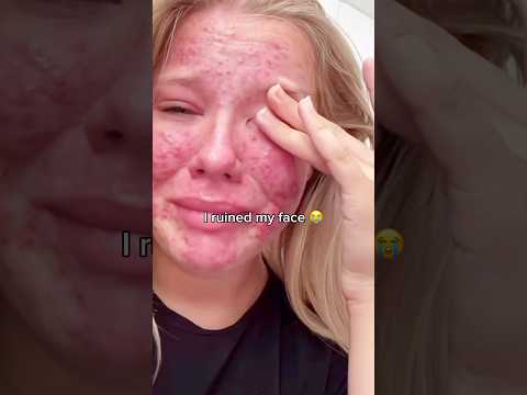 This ONE ingredient fixed my skin when NOTHING else worked ! 🤯 #beeftallow #skincare #acne #fyp