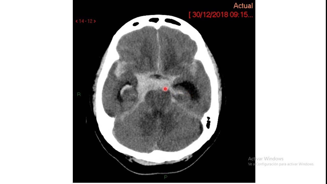 Hemorragia subaracnoidea - clasificación de Fisher .Dr Jorge Sibina