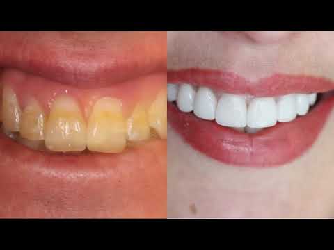 Ceramic Veneers at an affordable price