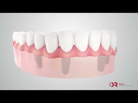 ALL-ON-4 metoda | Štimac Centar dentalne medicine | All on 4 metoda | Stomatološka poliklinika Zagreb | Štimac centar dentalne medicine