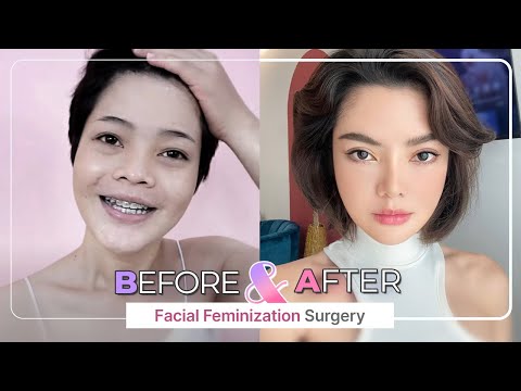 [SUB] Check out our Amazing Before and After FACIAL FEMINIZATION SURGERY (FFS) Top 5!