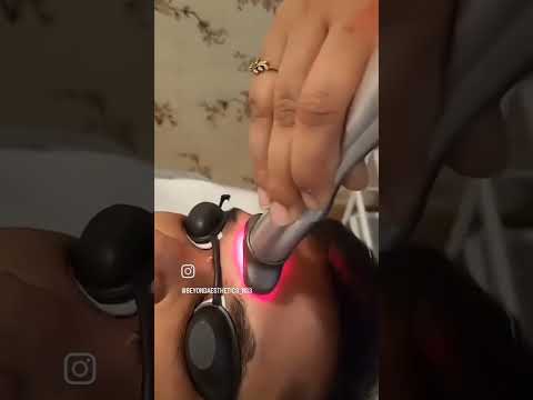 Sygmalift Cold Laser | Beyond Aesthetics by NS3