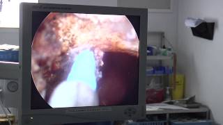 preview picture of video 'Le laser pour opérer la prostate à la Clinique de Martigues'
