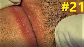 BLACKHEADS EXTRACTIONS on Happy&#39;s Upper Lip