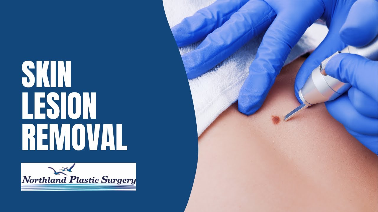 Skin Lesion Removal | Northland Plastic Surgery