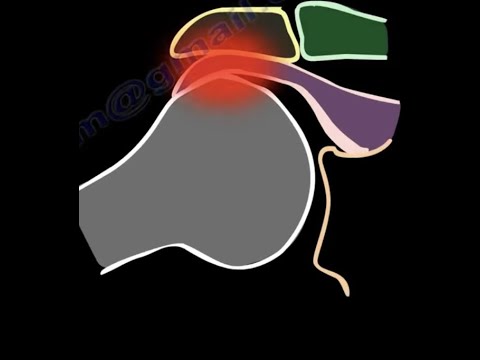 Shoulder Impingement Syndrome diagnosis and treatment, shoulder pain, shoulder bursitis, cuff tears.