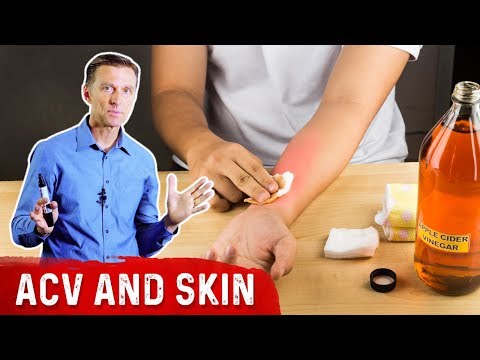 Will Apple Cider Vinegar Burn Your Skin or Heal It? – Dr.Berg
