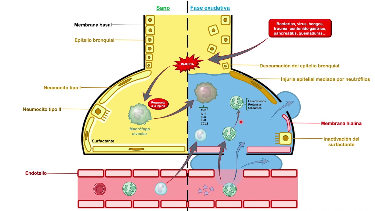 SDRA: Síndrome de Dificultad Respiratoria Aguda - Parte 1 (Definición, Fisiopatología y Diagnóstico)