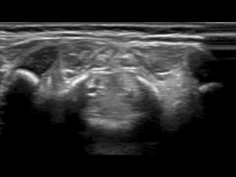 Spinal US - axial normal anatomy