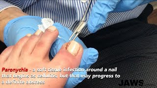 HOW TO REMOVE INFECTED INGROWN TOENAILS
