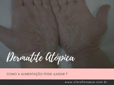 Eczema di nummulyarny della ragione La ragione di psoriasi su una faccia