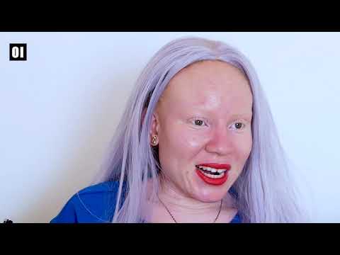 Benvinda Esperança: “Os albinos não curam doenças virais. Nós não somos medicamento”