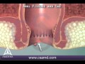 What Is An Anal Fissure 3D Animation
