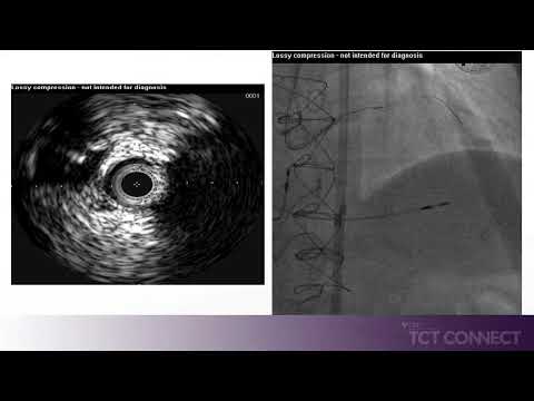 Complex CTO with Proximal Cap Ambiguity solved using IVUS Guided Puncture of the Proximal Cap