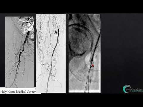 My Approach to Crossing SFA Occlusions - John Rundback, MD
