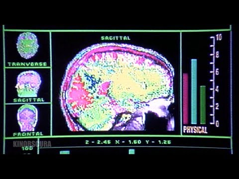 Rocky V (1990) - Brain Damage Cavum Septum