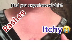 Itchy Neck-Itchy skin |||Home Remedy |ofw