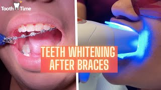 Braces Off - Teeth Whitening After Braces - Tooth Time Family Dentistry New Braunfels