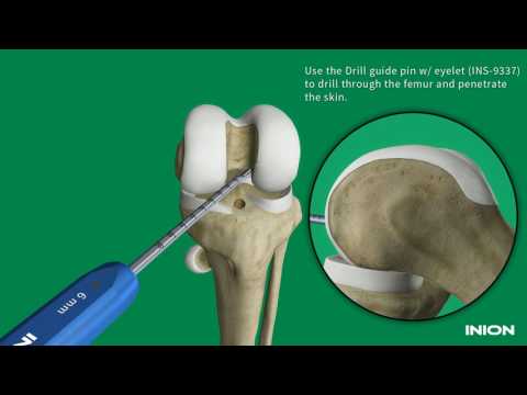 ACL Reconstruction Using the Inion Hexalon™ Screw and Inion FlipButton™
