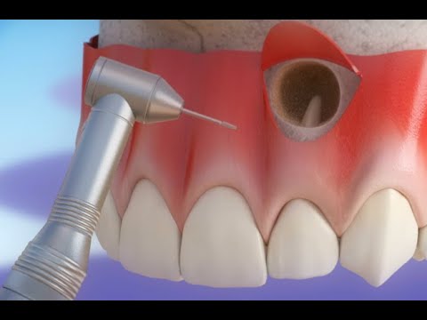 근단 절제술 – Apicoectomy ©