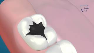 Empastes y reconstrucción