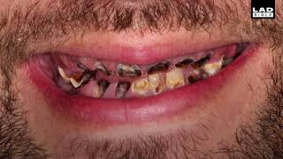 Dentist Fixes Rotten Teeth For Free