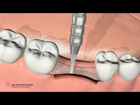 Zahnimplantat Köln - Erklärvideo, welche Schritte sind erforderlich?