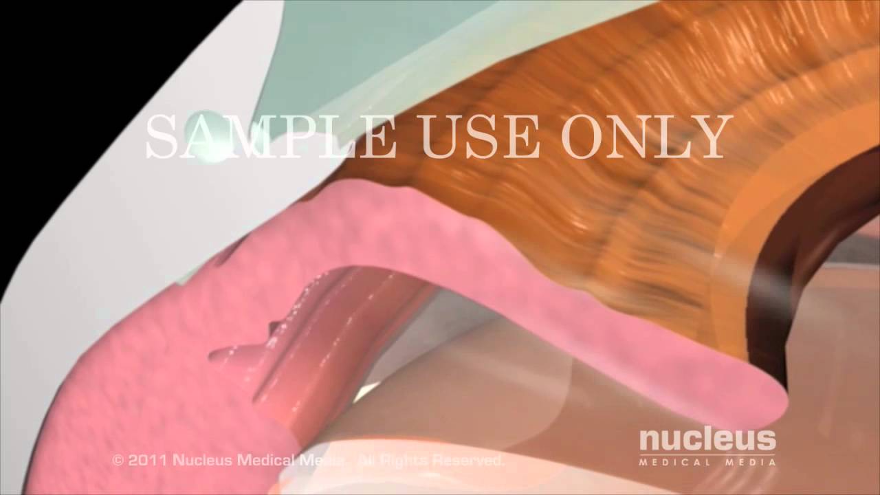 Watch Cirugía de glaucoma Now Cirugía de glaucoma