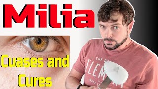 AVOID These Causes of Milia! | Hard White Bumps on Face and Eyes | Chris Gibson