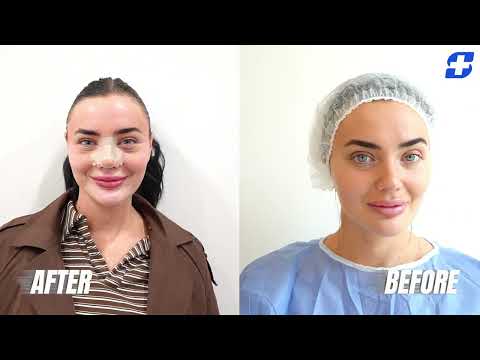 Kesia & Abbey's Rhinoplasty Journey | Sanamentujm