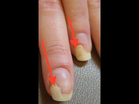 Die Behandlung utolschtschennogo des Nagels auf dem Bein Die Salbe von gribka die Liste des Fotos
