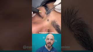Download lagu INTENSE mole removal! 😬 (credit: @cureme_medical_complex on TT) #viral #satisfying mp3 Download lagu INTENSE mole removal! 😬 (credit: @cureme_medical_complex on TT) #viral #satisfying mp3