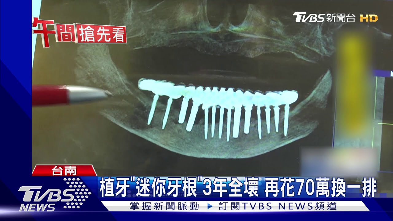 植牙「迷你牙根」3年全壞　再花70萬換一排