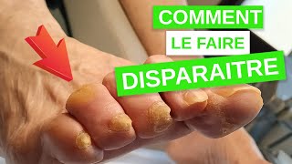 Comment faire disparaître un cor aux pieds 