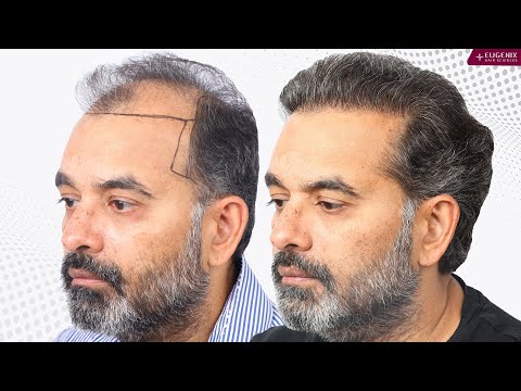Best Hair Transplant Results from Day 1 to Month 10