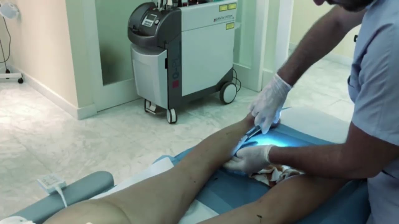Watch Now Aumento volume dei glutei e polpacci con acido ialuronico Hyacorp Aumento volume dei glutei e polpacci con acido ialuronico Hyacorp
