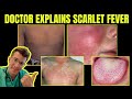 Doctor Explains SCARLET FEVER Group A Streptococcal Disease CAUSES SYMPTOMS TREATMENT