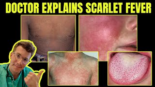 Doctor explains SCARLET FEVER (Group A Streptococcal disease) - CAUSES, SYMPTOMS &amp; TREATMENT