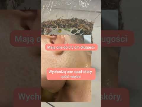 Pasożyty wychodzą przez skórę! Przekonajcie się sami. Zdjęcia!