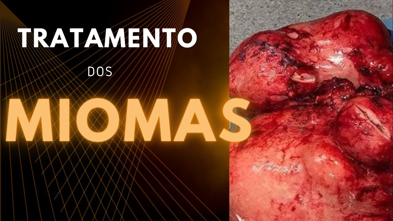 Remédios para mioma no útero