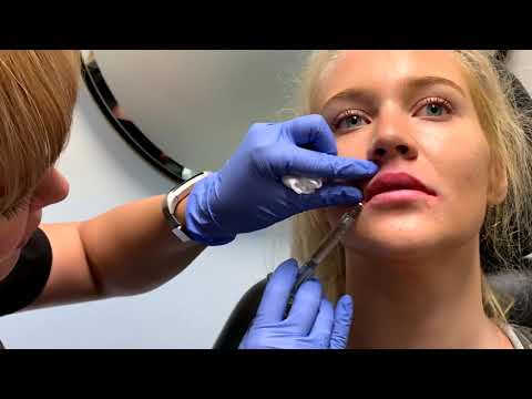 Juvederm Ultra with Onna| North Texas Plastic Surgery | Dallas, Texas